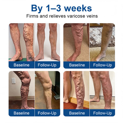 🇨🇦👨‍⚕️👍✅𝐂𝐚𝐫𝐞𝐔𝐩𝐥𝐢𝐟𝐭® VeinTarget Microneedle Patch⚡Instant Relief, Long-Term Results