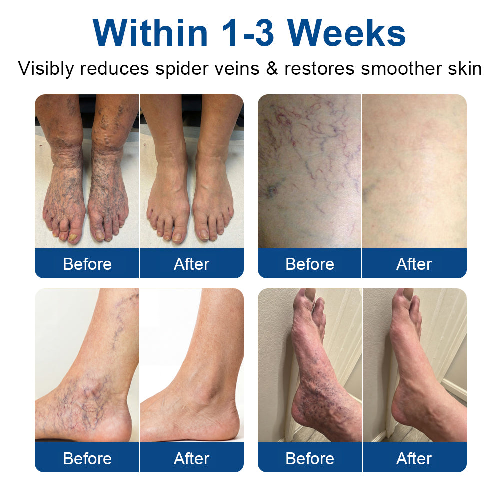 🇨🇦👨‍⚕️👍✅𝐂𝐚𝐫𝐞𝐔𝐩𝐥𝐢𝐟𝐭® VeinTarget Microneedle Patch⚡Instant Relief, Long-Term Results