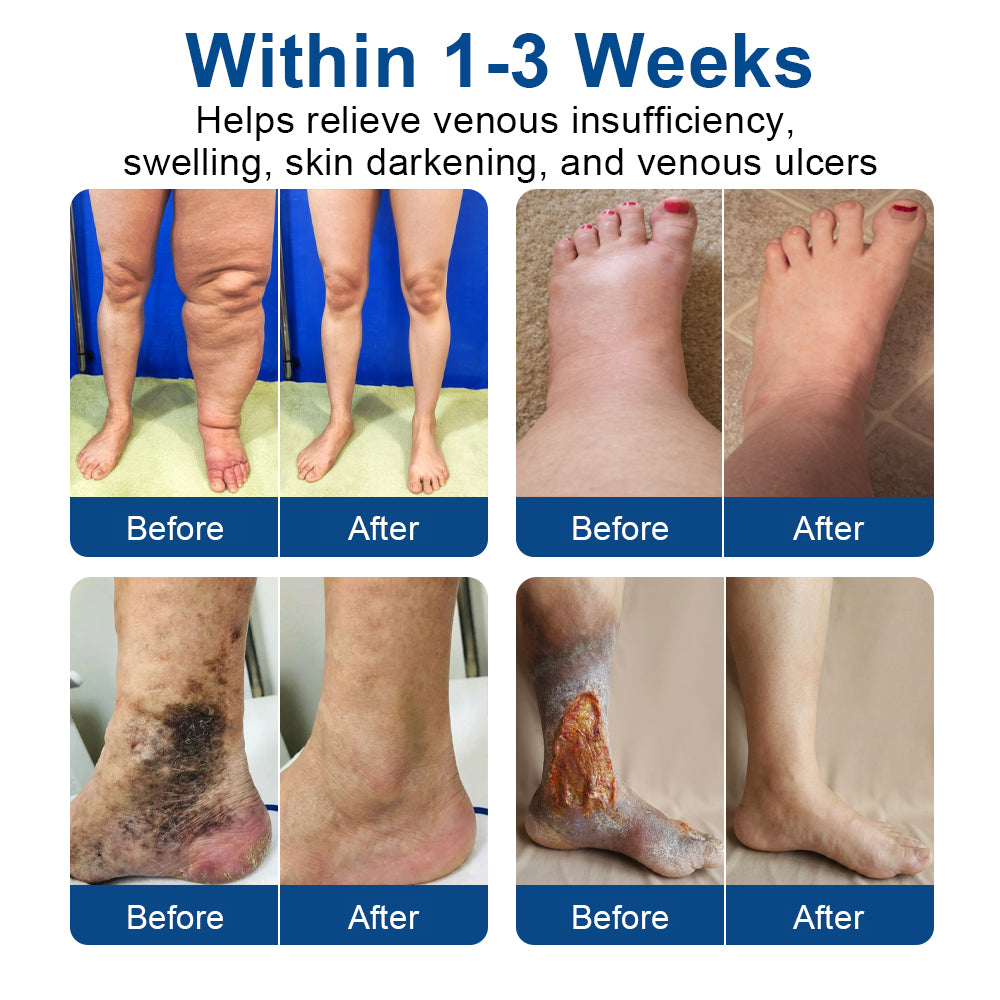 🇨🇦👨‍⚕️👍✅𝐂𝐚𝐫𝐞𝐔𝐩𝐥𝐢𝐟𝐭® VeinTarget Microneedle Patch⚡Instant Relief, Long-Term Results