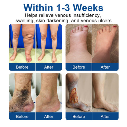 🇨🇦👨‍⚕️👍✅𝐂𝐚𝐫𝐞𝐔𝐩𝐥𝐢𝐟𝐭® VeinTarget Microneedle Patch⚡Instant Relief, Long-Term Results