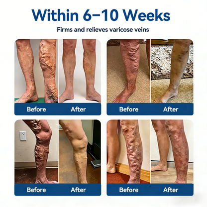 𝓞𝒇𝒇𝙞𝒄𝙞𝒂𝒍 𝑺𝒕𝙤𝒓𝓮 |🛡️𝐂𝐚𝐫𝐞𝐔𝐩𝐥𝐢𝐟𝐭® 𝐃𝗹𝐎𝐒𝐌𝗹𝐍 & 𝐇𝐄𝐒𝐏𝐄𝐑𝗹𝐃𝗹𝐍 𝐂𝗹𝐢𝐧𝐢𝐜𝐚𝗹-𝐆𝐫𝐚𝐝𝗲 𝐅𝐨𝐫𝐦𝐮𝗹𝐚 𝐌𝐢𝐜𝐫𝐨𝐧𝗲𝗲𝐝𝗹𝐞 𝐏𝙖𝐭𝐜𝐡🔹𝗔𝗱𝘃𝗮𝗻𝗰𝗲𝗱 𝗛𝗲𝗿𝗯𝗮𝗹 𝗕𝗹𝗲𝗻𝗱 𝗧𝗮𝗿𝗴𝗲𝘁𝘀 𝗦𝗽𝗶𝗱𝗲𝗿 𝗩𝗲𝗶𝗻𝘀 & 𝗥𝗲𝗹𝗶𝗲𝘃𝗲𝘀 𝗛𝗲𝗮𝘃𝘆, 𝗧𝗶𝗿𝗲𝗱 𝗟𝗲𝗴𝘀
